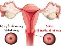 Viêm lộ tuyến cổ tử cung – bệnh phụ khoa không thể chủ quan – Phòng Khám Hưng Thịnh