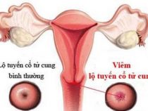 Khám và điều trị bệnh viêm lộ tuyến cổ tử cung ở đâu? – Phòng Khám Hưng Thịnh