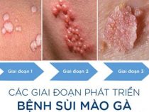 Làm sao để phát hiện sùi mào gà ở giai đoạn đầu? – Phòng Khám Hưng Thịnh