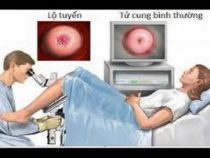 Quy trình khám bệnh viêm lộ tuyến cổ tử cung đúng cách – Phòng Khám Hưng Thịnh