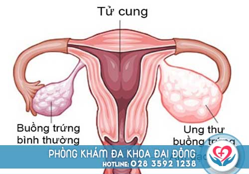Bệnh u nang buồng trứng là bệnh phụ khoa thường gặp