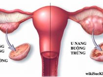 [ chứng bệnh u nang buồng trứng ] Nguyên nhân , triệu chứng và cách điều trị