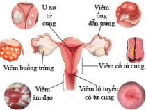 Bệnh phụ khoa Cách phòng tránh và điều trị hữu hiệu