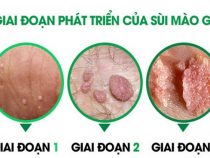 Dấu hiệu nhận biết + cách điều trị hữu hiệu !