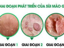 [ Tổng hợp ] Hình ảnh sùi mào gà ở nam và nữ giới các thời kỳ