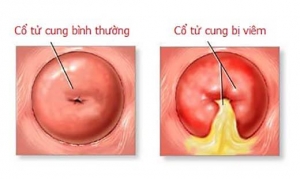 dấu hiệu viêm cổ tử cung