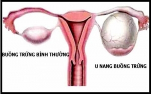 u nang buồng trứng phải có nguy hiểm không