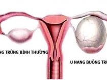  U nang buồng trứng Có thai được không, phải kiêng gì ?