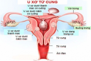 u xơ tử cung là như nào