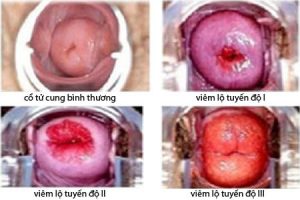 Bị ngứa ngáy vùng kín do viêm lộ tuyến cổ tử cung