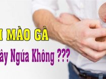 [ Sùi mào gà có ngứa ngáy không ? ]