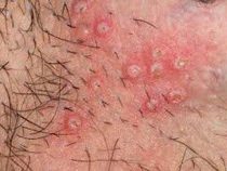 Mẩn ngứa ngáy vùng kín ở nữ giới là vì đâu ? Cách chữa trị tốt nhất