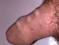 Găm bi có tác dụng gì cho “cuộc yêu” ? mức phí gắn bi có đắt không