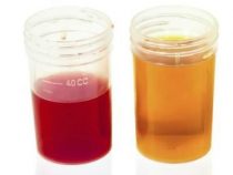Nước tiểu màu đỏ là chứng bệnh gì & nguy hiểm không [ Giải Đáp ]