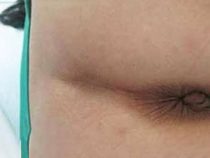 [ Giải Đáp ] Hậu môn có cục thịt thừa là căn bệnh gì & cách xử lý