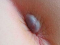 [ Tìm hiểu ] Nổi cục thịt ở hậu môn cảnh báo 5 căn bệnh nguy hiểm