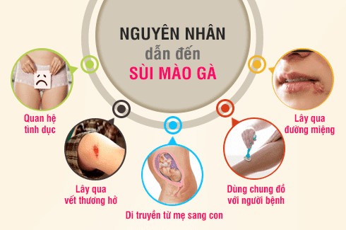 Nguyên nhân gây bệnh sùi mào gà