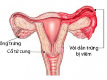 [ GIẢI ĐÁP ] Viêm ống dẫn trứng có nguy hiểm không ? 3 cách điều trị hữu hiệu