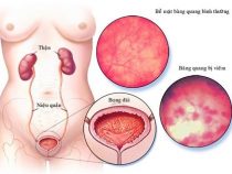 [ Review ] 5+ bài bấm huyệt trị viêm bọng đái hữu hiệu nhanh chóng