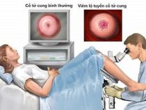 [ Giải Đáp ] Chưa sinh con có nên đốt viêm lộ tuyến thường hay không ?