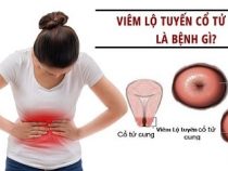 [ Giải Đáp ] Viêm lộ tuyến có tự khỏi được không và điều trị bằng cách nào hữu hiệu