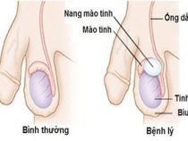 [Giải đáp] Nang mào tinh hoàn có khỏi được không và điều trị thế nào hữu hiệu ?