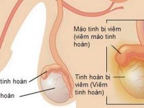 [ Review ] trị nang mào tinh hoàn ra sao là tốt nhất và tiết kiệm phí ?