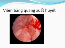 [ THÔNG TIN ] 3 cách điều trị viêm bọng đái xuất huyết tốt nhất và an toàn