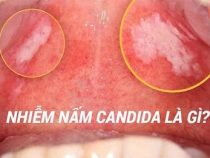 [ Tổng hợp ] 5+ hình ảnh mắc phải nhiễm nấm Candida chi tiết của nam và nữ giới