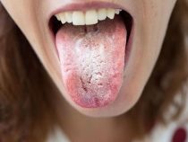 [ Tổng hợp ] 5+ dấu hiệu nấm candida ở miệng dễ nhận biết nhất