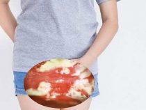 [ Review ] 15+ cách trị nấm Candida ở vùng kín hữu hiệu nhanh và an toàn