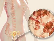 [ Review ] 3+ cách điều trị nấm candida tái phát hữu hiệu và an toàn hiện nay
