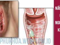 [ Giải Đáp ] Nấm Candida có nguy hiểm không và trị thế nào hữu hiệu hiện nay