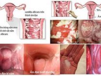[ Review ] Viên đặt trị nấm Candida Nhật Bạn có tốt nhất thường hay không ?