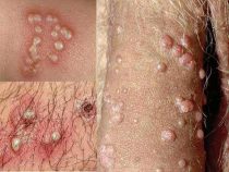 Bao quy đầu nổi mẩn đỏ có thể là dấu hiệu bệnh nguy hiểm – Phòng Khám Hưng Thịnh