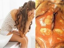 căn bệnh hạ cam và cách phòng tránh căn bệnh như thế nào? – Phòng kiểm tra Hưng Thịnh