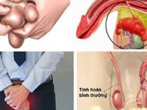 Cách điều trị đau đớn tinh hoàn ở nam giới như thế nào? – Phòng kiểm tra Hưng Thịnh