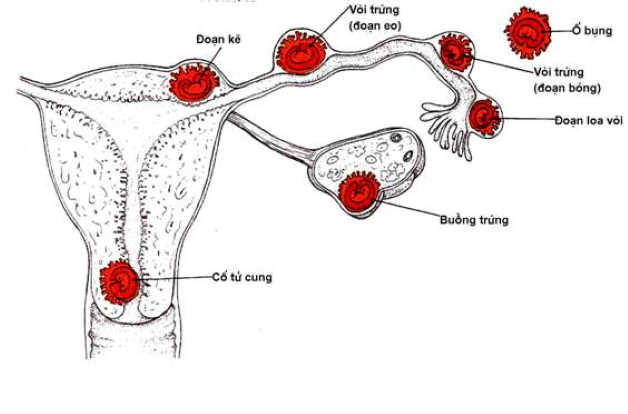 Chi phí điều trị thai ngoài tử cung