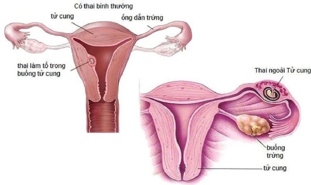 Có thai ngoài tử cung là gì