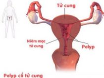 Điều trị chứng bệnh polyp cổ tử cung như thế nào? – Phòng xét nghiệm Hưng Thịnh