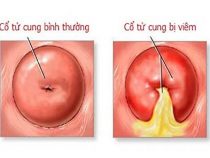 Điều trị chứng bệnh viêm cổ tử cung liệu có không dễ dàng như bạn nghĩ không? – Phòng thăm khám Hưng Thịnh