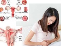 Điều trị căn bệnh viêm phụ khoa ở đâu tại Hà Nội? – Phòng kiểm tra Hưng Thịnh