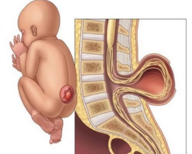 Khiếm khuyết ống thần kinh