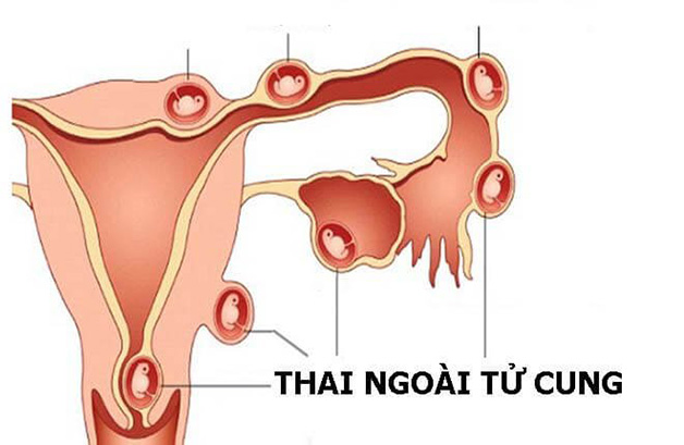 Mang thai ngoài tử cung