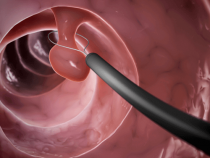 Nguy hại mà căn bệnh polyp cổ tử cung gây nên ra – Phòng thăm khám Hưng Thịnh