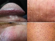 Nguyên nhân gặp phải mụn cóc sinh dục là vì đâu? – Phòng kiểm tra Hưng Thịnh