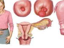 Nguyên nhân chị em mắc căn bệnh polyp cổ tử cung – Phòng xét nghiệm Hưng Thịnh