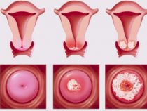 Nguyên nhân gây ra viêm cổ tử cung nữ giới cần phải phải biết – Phòng thăm khám Hưng Thịnh