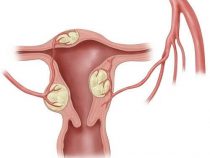 Nguyên nhân nào dẫn tới u xơ tử cung thường gặp – Phòng kiểm tra Hưng Thịnh