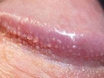 Những điều cần phải biết về chuỗi hạt ngọc dương vật – Phòng xét nghiệm Hưng Thịnh